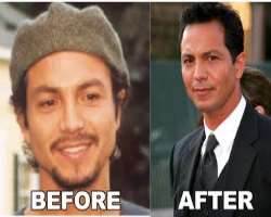 Benjamin Bratt before surgery